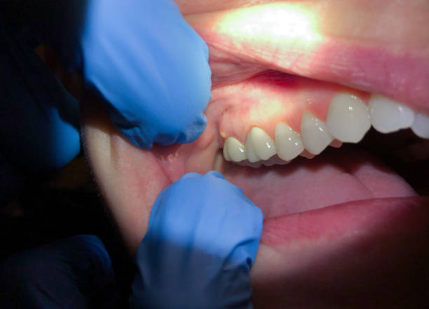 Best Tooth Infection Emergency Dentist  in Lexington Park, MD
